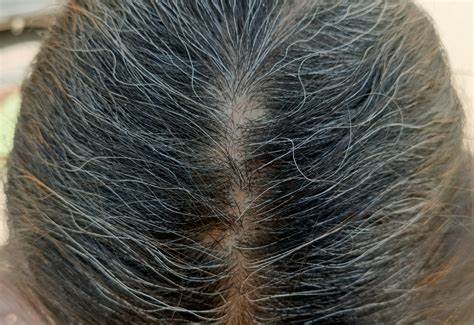 Accept Natural Solutions: Recognizing White Hair Causes and Preventative Steps